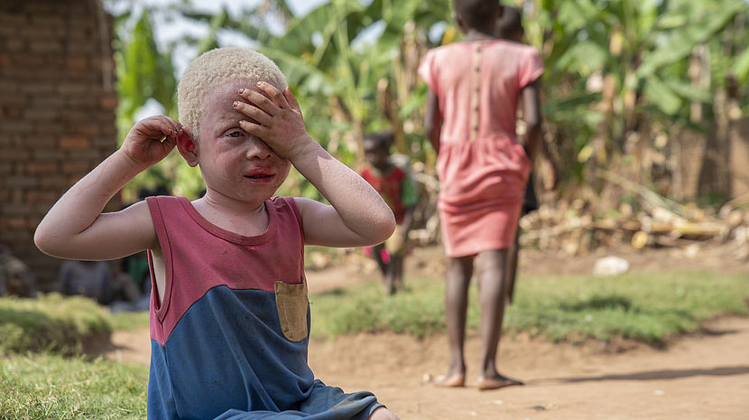 A 4 year old girl with albinism sitting alone and covering her face. Other children are playing in the background