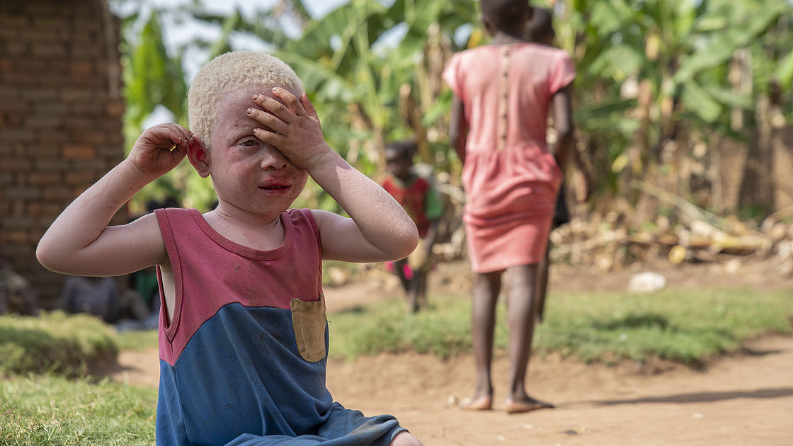 A 4 year old girl with albinism sitting alone and covering her face. Other children are playing in the background